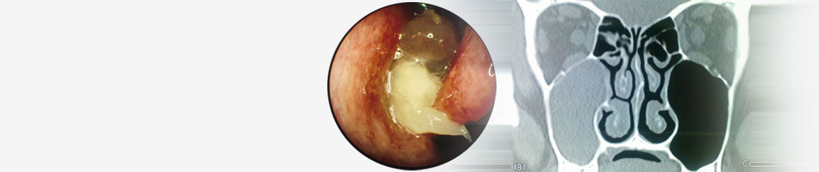 Sinusitis Surgery in India, Functional Endoscopic Sinus Surgery In Delhi, India