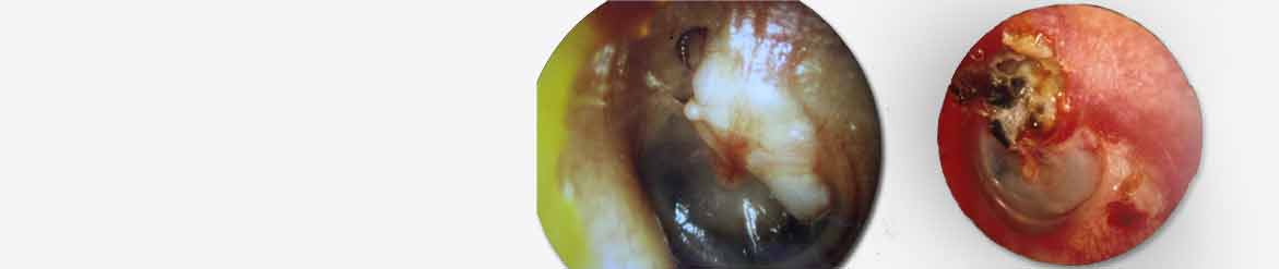 Mastoidectomy Surgery In India, ENT specialist in india, Best ENT surgeon in india