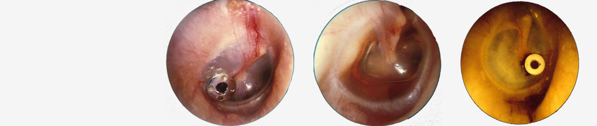 Myringotomy & Ventilation Tubes, ENT specialist in india, Best ENT surgeon in india