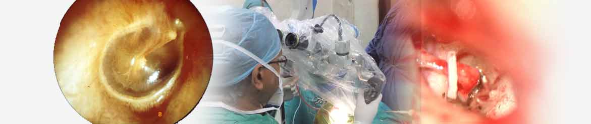 Stapedotomy, ENT specialist in india, Best ENT surgeon in india