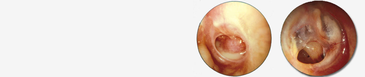 Tympanoplasty Surgery In India, ENT specialist in india